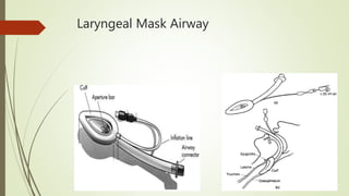Laryngeal Mask Airway
 