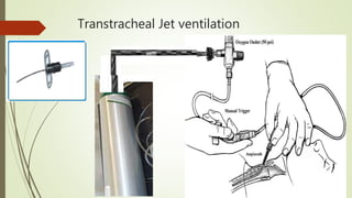 Transtracheal Jet ventilation
 
