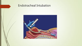 Endotracheal Intubation
 