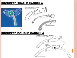 UNCUFFED SINGLE CANNULA
UNCUFFED DOUBLE CANNULA
 