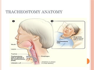 TRACHEOSTOMY ANATOMY
 