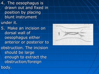 4. The oesophagus is
  drawn out and fixed in
  position by placing
  blunt instrument
under it.
5. Make an incision on
  dorsal wall of
  oesophagus either
  anterior or posterior to
obstruction. The incision
  should be large
  enough to extract the
  obstruction/foreign
body.
 