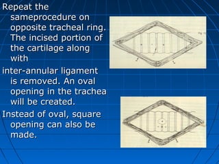 Repeat the
  sameprocedure on
  opposite tracheal ring.
  The incised portion of
  the cartilage along
  with
inter-annular ligament
  is removed. An oval
  opening in the trachea
  will be created.
Instead of oval, square
  opening can also be
  made.
 