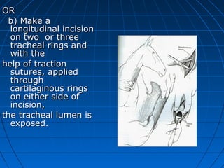 OR
 b) Make a
  longitudinal incision
  on two or three
  tracheal rings and
  with the
help of traction
  sutures, applied
  through
  cartilaginous rings
  on either side of
  incision,
the tracheal lumen is
  exposed.
 