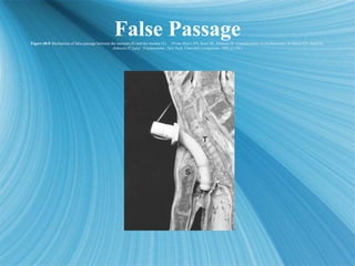 False Passage
Figure 68-8 Mechanism of false passage between the sternum (S) and the trachea (T). (From Myers EN, Stool SE...