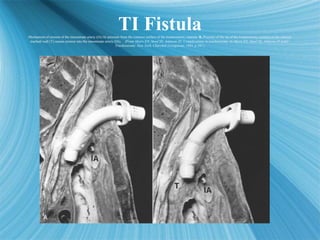 TI Fistula
Mechanism of erosion of the innominate artery (IA) by pressure from the concave surface of the tracheostomy can...