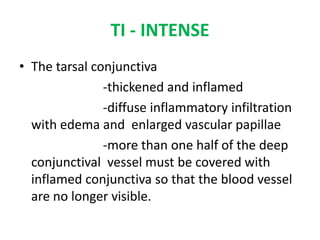 TI - INTENSE
• The tarsal conjunctiva
-thickened and inflamed
-diffuse inflammatory infiltration
with edema and enlarged vascular papillae
-more than one half of the deep
conjunctival vessel must be covered with
inflamed conjunctiva so that the blood vessel
are no longer visible.

 