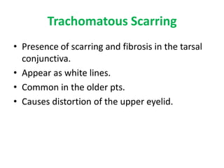 Trachomatous Scarring
• Presence of scarring and fibrosis in the tarsal
conjunctiva.
• Appear as white lines.
• Common in the older pts.
• Causes distortion of the upper eyelid.

 