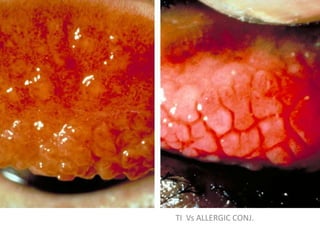 TI Vs ALLERGIC CONJ.

 