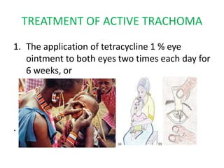 TREATMENT OF ACTIVE TRACHOMA
1. The application of tetracycline 1 % eye
ointment to both eyes two times each day for
6 weeks, or

.

 