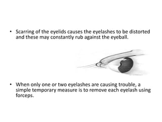 • Scarring of the eyelids causes the eyelashes to be distorted
and these may constantly rub against the eyeball.

• When only one or two eyelashes are causing trouble, a
simple temporary measure is to remove each eyelash using
forceps.

 