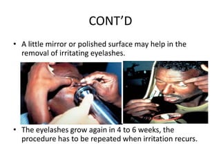 CONT’D
• A little mirror or polished surface may help in the
removal of irritating eyelashes.

• The eyelashes grow again in 4 to 6 weeks, the
procedure has to be repeated when irritation recurs.

 
