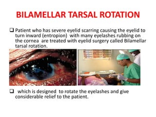BILAMELLAR TARSAL ROTATION
 Patient who has severe eyelid scarring causing the eyelid to
turn inward (entropion) with many eyelashes rubbing on
the cornea are treated with eyelid surgery called Bilamellar
tarsal rotation.

 which is designed to rotate the eyelashes and give
considerable relief to the patient.

 