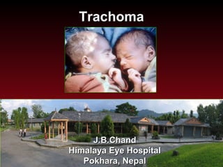 TrachomaTrachoma
J.B.ChandJ.B.Chand
Himalaya Eye HospitalHimalaya Eye Hospital
Pokhara, NepalPokhara, Nepal
 