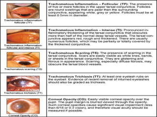 Trachoma Follicles