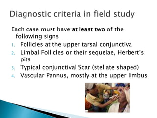 Each case must have at least two of the
following signs
1. Follicles at the upper tarsal conjunctiva
2. Limbal Follicles or their sequelae, Herbert’s
pits
3. Typical conjunctival Scar (stellate shaped)
4. Vascular Pannus, mostly at the upper limbus
 