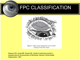 FPC CLASSIFICATION
Dawson CR, Jones BR, Tarizzo ML. Guide to trachoma control in
programmes for the prevention of blindness. Geneva: World Health
Organization, 1981
 