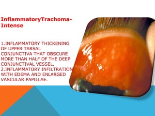 Trachom Trachoma | PPT
