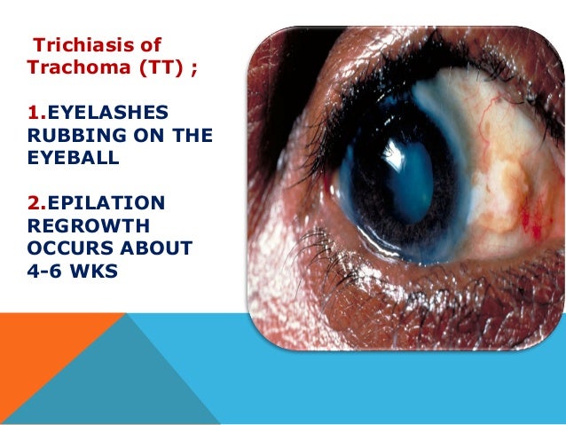 grading grade 4-6 sheet Trachoma