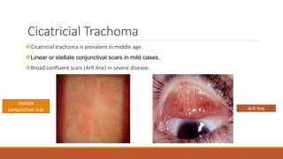 Trachoma | PPTX