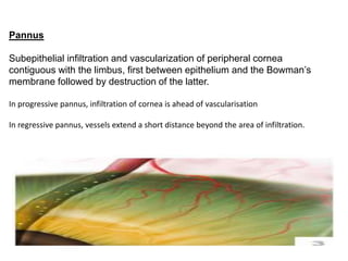 Pannus
Subepithelial infiltration and vascularization of peripheral cornea
contiguous with the limbus, first between epithelium and the Bowman’s
membrane followed by destruction of the latter.
In progressive pannus, infiltration of cornea is ahead of vascularisation
In regressive pannus, vessels extend a short distance beyond the area of infiltration.
 