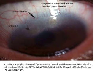 https://www.google.co.in/search?q=pannus+trachoma&dcr=0&source=lnms&tbm=isch&sa
=X&ved=0ahUKEwjLtNObr9XWAhWHMY8KHUSaDlsQ_AUICigB&biw=1163&bih=594#imgrc
=A8-aL2De9QkNNM:
 