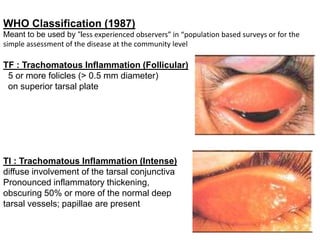 WHO Classification (1987)
Meant to be used by “less experienced observers” in “population based surveys or for the
simple assessment of the disease at the community level
TF : Trachomatous Inflammation (Follicular)
5 or more folicles (> 0.5 mm diameter)
on superior tarsal plate
TI : Trachomatous Inflammation (Intense)
diffuse involvement of the tarsal conjunctiva
Pronounced inflammatory thickening,
obscuring 50% or more of the normal deep
tarsal vessels; papillae are present
 