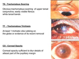 TS : Trachomatous Scarring
Obvious trachomatous scarring of upper tarsal
conjunctiva, easily visible fibrous
white tarsal bands
TT : Trachomatous Trichiasis
At least 1 trichiatic cilia rubbing on
the globe or evidence of its recent removal
CO : Corneal Opacity
Corneal opacity sufficient to blur details of
atleast part of the pupillary margin
 