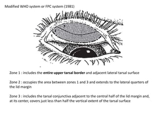 Zone 1 : includes the entire upper tarsal border and adjacent lateral tarsal surface
Zone 2 : occupies the area between zones 1 and 3 and extends to the lateral quarters of
the lid margin
Zone 3 : includes the tarsal conjunctiva adjacent to the central half of the lid margin and,
at its center, covers just less than half the vertical extent of the tarsal surface
Modified WHO system or FPC system (1981)
 