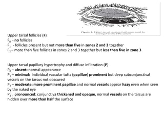Upper tarsal follicles (F)
F0 - no follicles
F1 - follicles present but not more than five in zones 2 and 3 together
F2 – more than five follicles in zones 2 and 3 together but less than five in zone 3
Upper tarsal papillary hypertrophy and diffuse infiltration (P)
P0 – absent: normal appearance
P1 – minimal: individual vascular tufts (papillae) prominent but deep subconjunctival
vessels on the tarsus not obscured
P2 – moderate: more prominent papillae and normal vessels appear hazy even when seen
by the naked eye
P3 - pronounced: conjunctiva thickened and opaque, normal vessels on the tarsus are
hidden over more than half the surface
 