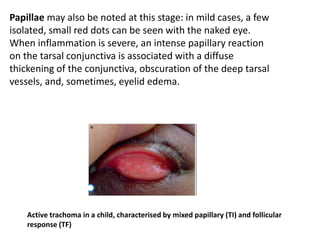Papillae may also be noted at this stage: in mild cases, a few
isolated, small red dots can be seen with the naked eye.
When inflammation is severe, an intense papillary reaction
on the tarsal conjunctiva is associated with a diffuse
thickening of the conjunctiva, obscuration of the deep tarsal
vessels, and, sometimes, eyelid edema.
Active trachoma in a child, characterised by mixed papillary (TI) and follicular
response (TF)
 