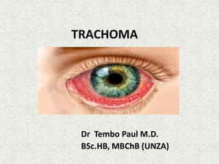 TRACHOMA
Dr Tembo Paul M.D.
BSc.HB, MBChB (UNZA)
 