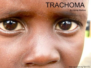 TRACHOMA
By Anna Melton
http://go-near.org/?p=172
 
