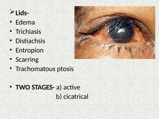Lids-
• Edema
• Trichiasis
• Distiachsis
• Entropion
• Scarring
• Trachomatous ptosis
• TWO STAGES- a) active
b) cicatrical
 