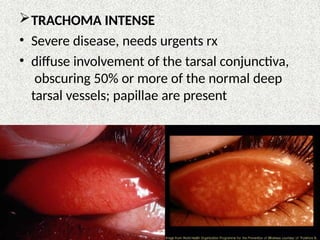 TRACHOMA INTENSE
• Severe disease, needs urgents rx
• diffuse involvement of the tarsal conjunctiva,
obscuring 50% or more of the normal deep
tarsal vessels; papillae are present
 