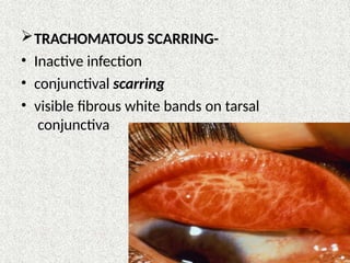 TRACHOMATOUS SCARRING-
• Inactive infection
• conjunctival scarring
• visible fibrous white bands on tarsal
conjunctiva
 