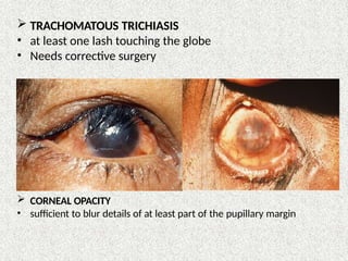 TRACHOMATOUS TRICHIASIS
• at least one lash touching the globe
• Needs corrective surgery
 CORNEAL OPACITY
• sufficient to blur details of at least part of the pupillary margin
 