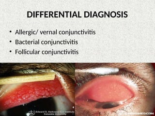 DIFFERENTIAL DIAGNOSIS
• Allergic/ vernal conjunctivitis
• Bacterial conjunctivitis
• Follicular conjunctivitis
 