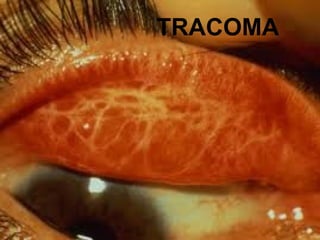 TRACOMA
 