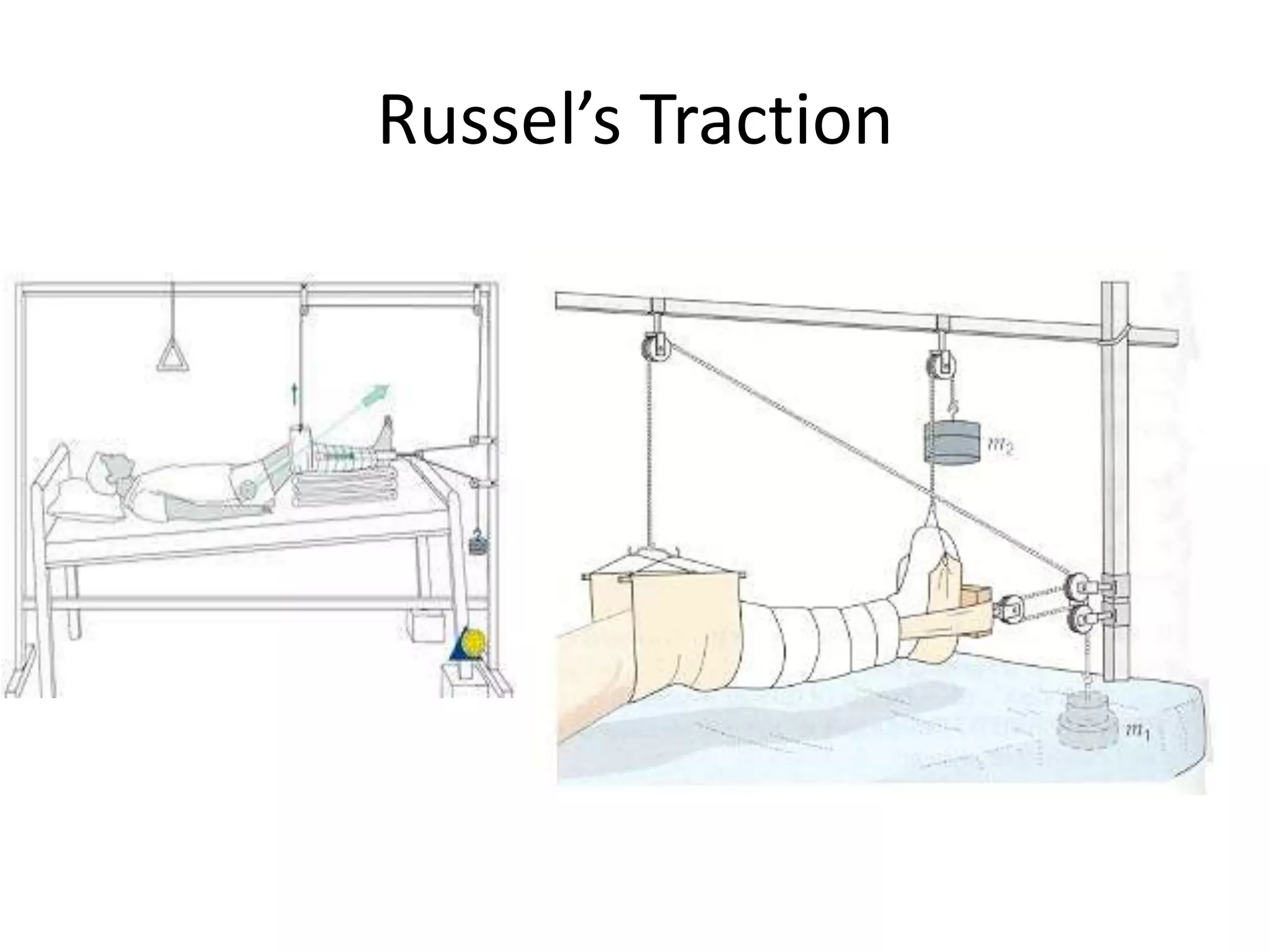 Russel’s Traction