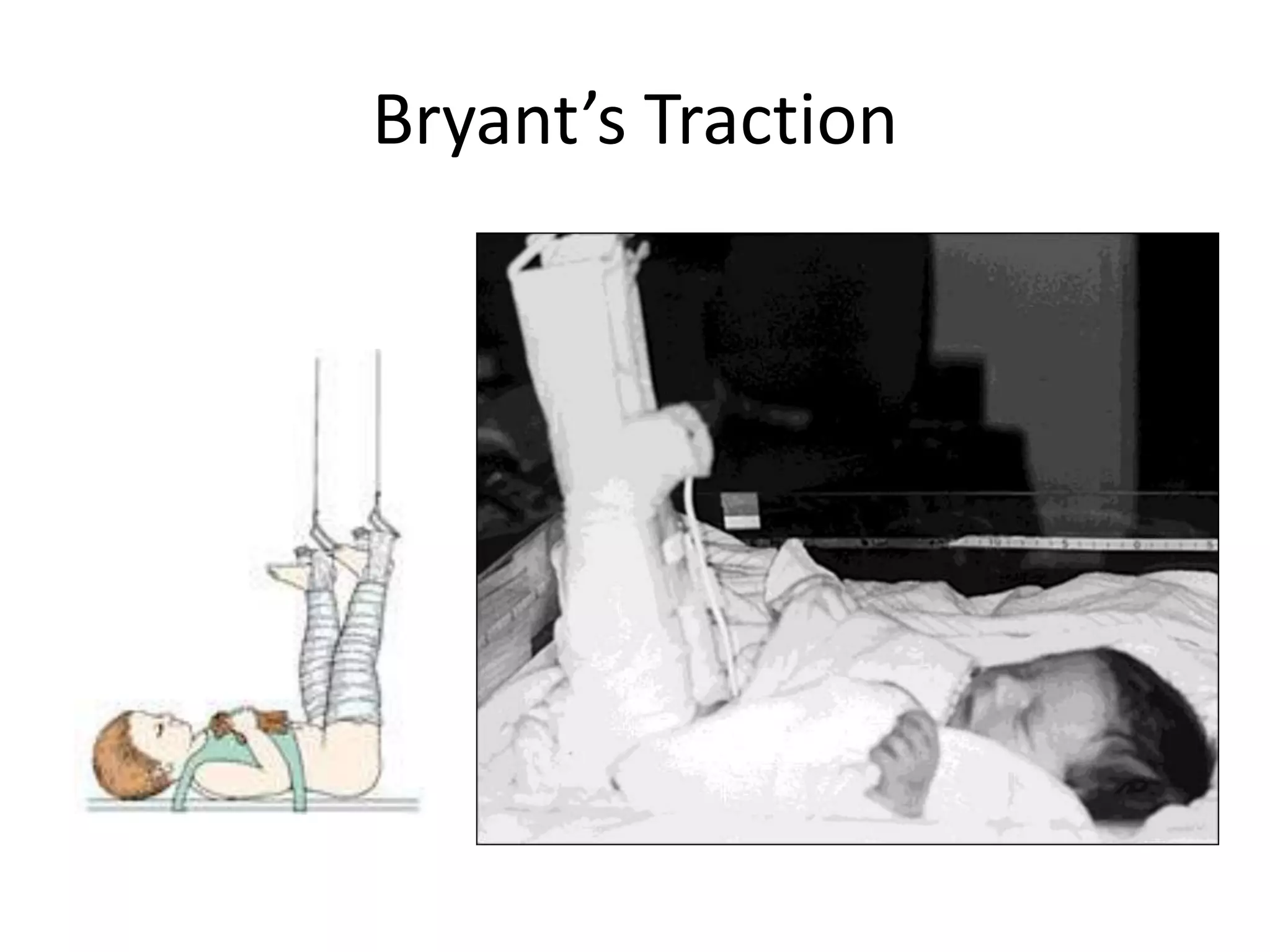 Bryant’s Traction