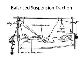 Balanced Suspension Traction