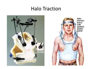 Halo Traction