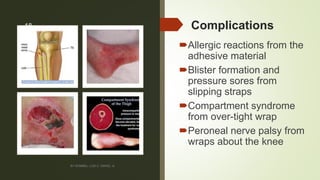 Complications
Allergic reactions from the
adhesive material
Blister formation and
pressure sores from
slipping straps
Compartment syndrome
from over-tight wrap
Peroneal nerve palsy from
wraps about the knee
BY ROMMEL LUIS C. ISRAEL III
18
 