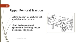 Upper Femoral Traction
Lateral traction for fractures with
medial or anterior force.
Stretched capsule and
ligamentum teres may reduce
acetabular fragments.
BY ROMMEL LUIS C. ISRAEL III
28
 