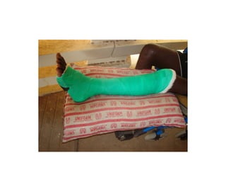 TRACTION AND SPLINTS IN ORTHOPAEDICS new.ppt