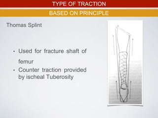 TYPE OF TRACTION
BASED ON PRINCIPLE
Thomas Splint
• Used for fracture shaft of
femur
• Counter traction provided
by ischeal Tuberosity
 