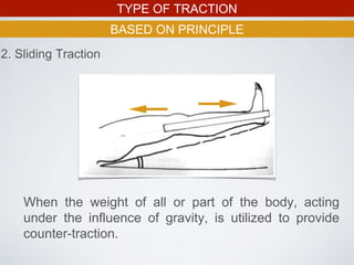 TYPE OF TRACTION
BASED ON PRINCIPLE
When the weight of all or part of the body, acting
under the influence of gravity, is utilized to provide
counter-traction.
2. Sliding Traction
 