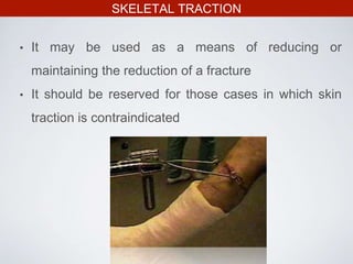 SKELETAL TRACTION
• It may be used as a means of reducing or
maintaining the reduction of a fracture
• It should be reserved for those cases in which skin
traction is contraindicated
 