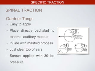 SPECIFIC TRACTION
SPINAL TRACTION
• Easy to apply
• Place directly cephalad to
external auditory meatus
• In line with mastoid process
• Just clear top of ears
• Screws applied with 30 lbs
pressure
Gardner Tongs
 
